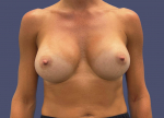 Breast Augmentation 30 After